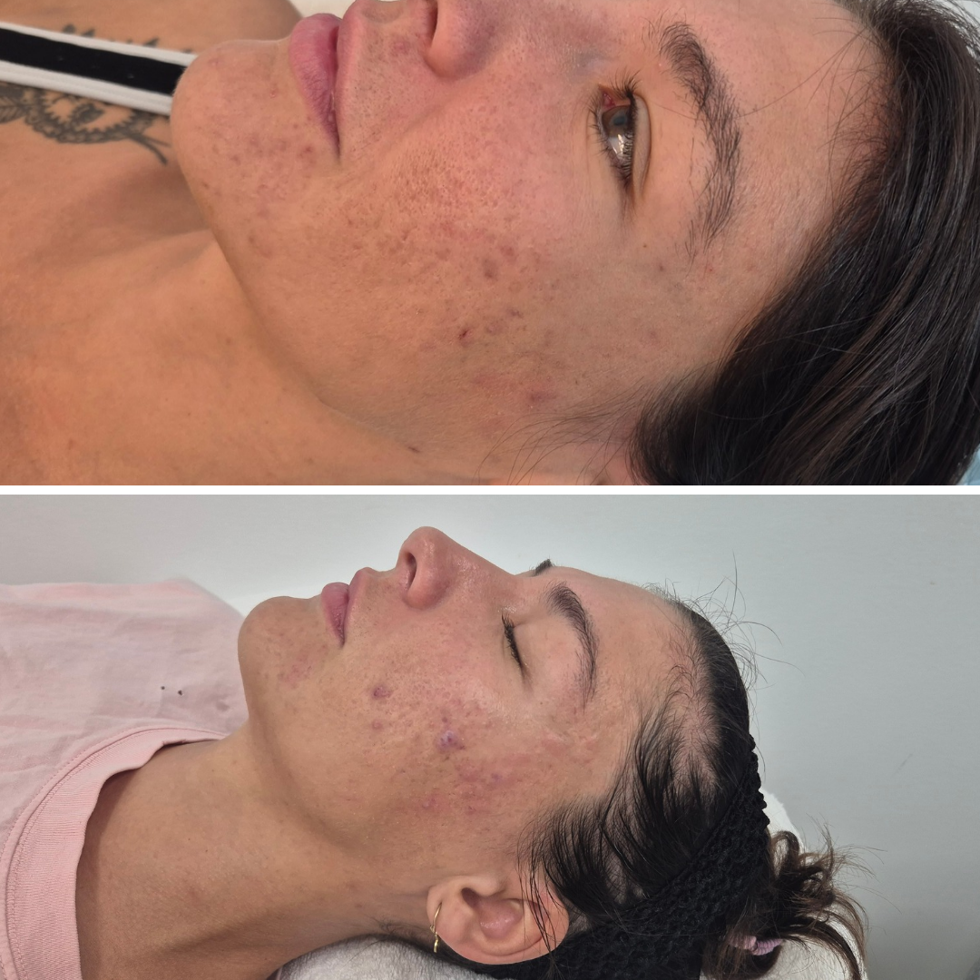 Before and After a series of treatments including microdermabrasion