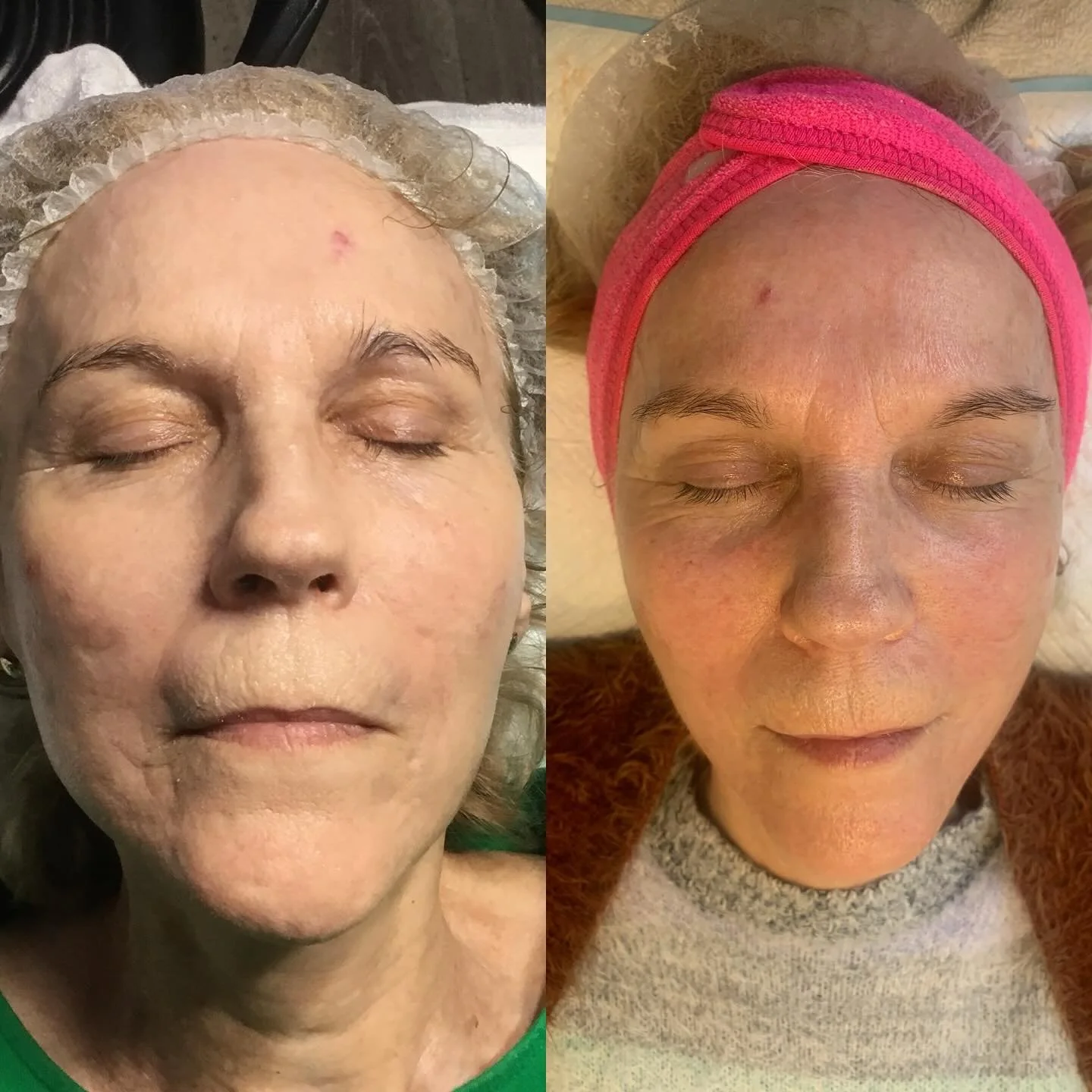 Side-by-side comparison of a woman’s face before and after skincare treatment, with her eyes closed in both images. The left shows her face with visible skin issues, and the right shows a clearer, more radiant complexion.