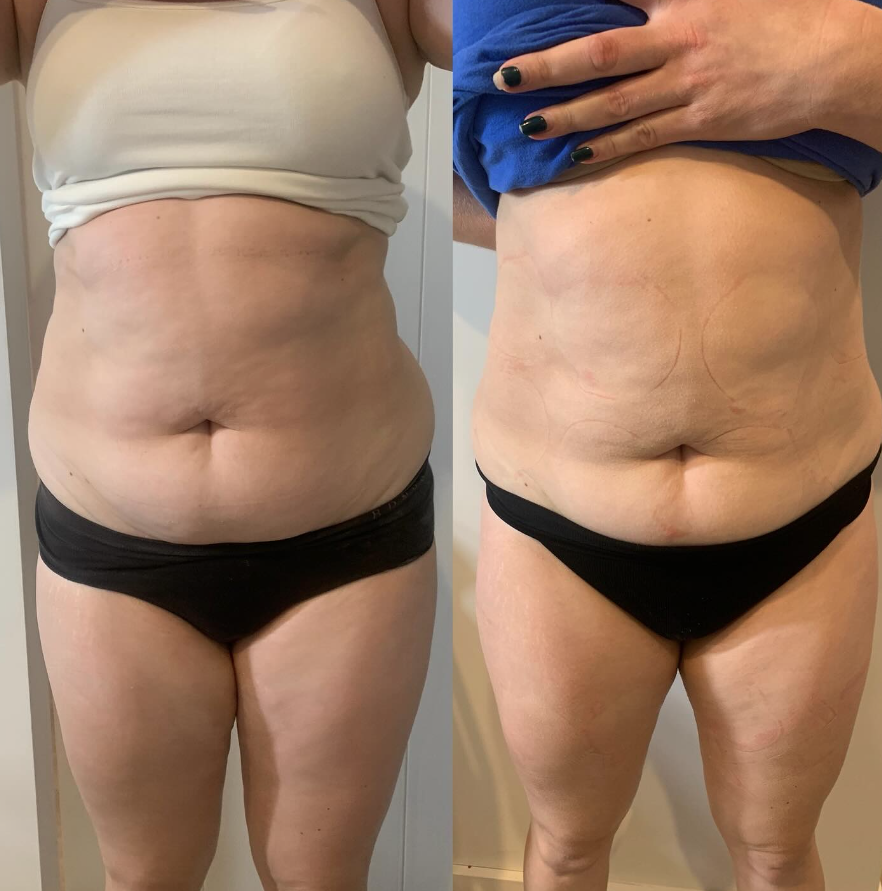 Before & After 4 EMS Sessions to abdomen