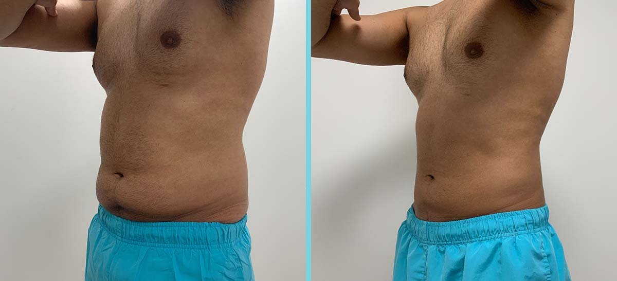 BEFORE AND 12 WEEKS POST FAT FREEZING