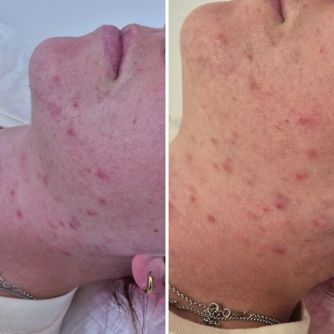 Before and After a series of microdermabrasion