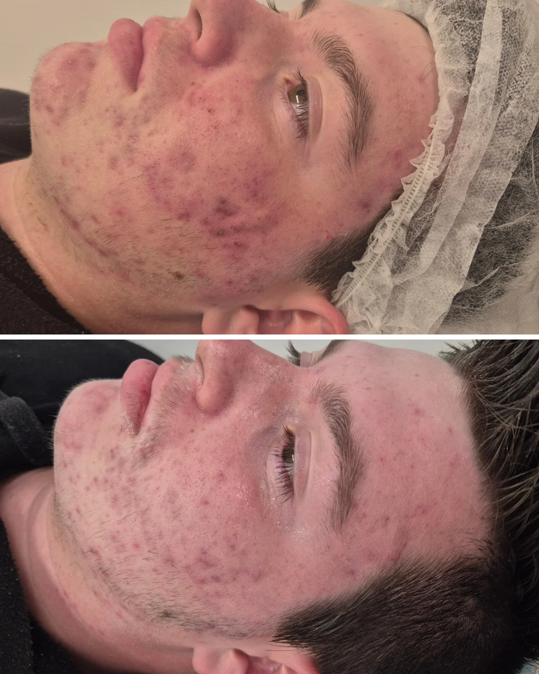 Before and After a series of Treatments including microdermabrasion
