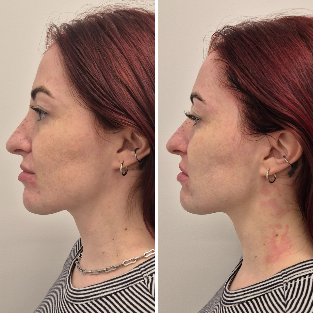 Before & Immediately After HIFU Treatment  lower Face