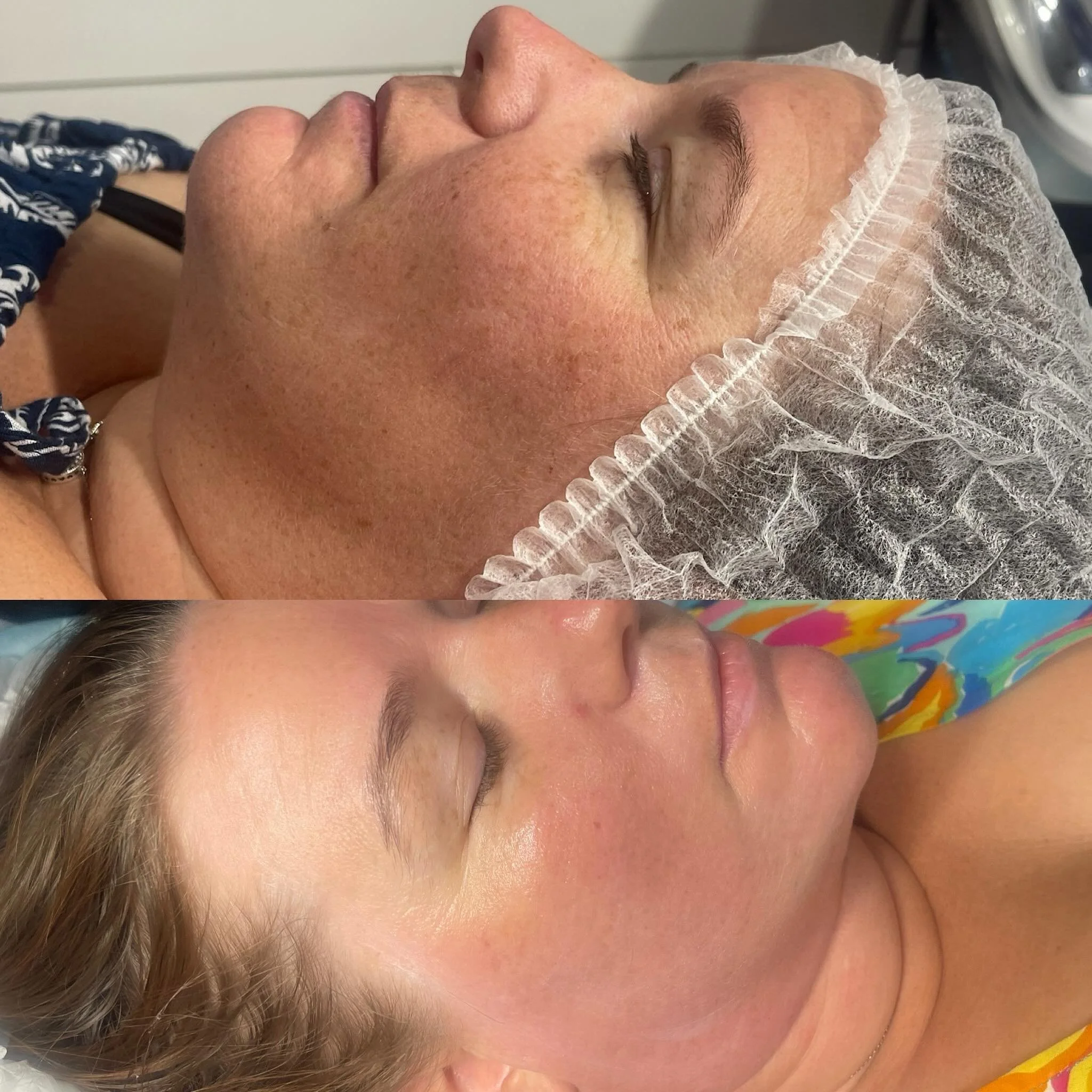 Before and after images of a woman's face showing improvements in skin appearance, likely from a cosmetic or skincare treatment.
