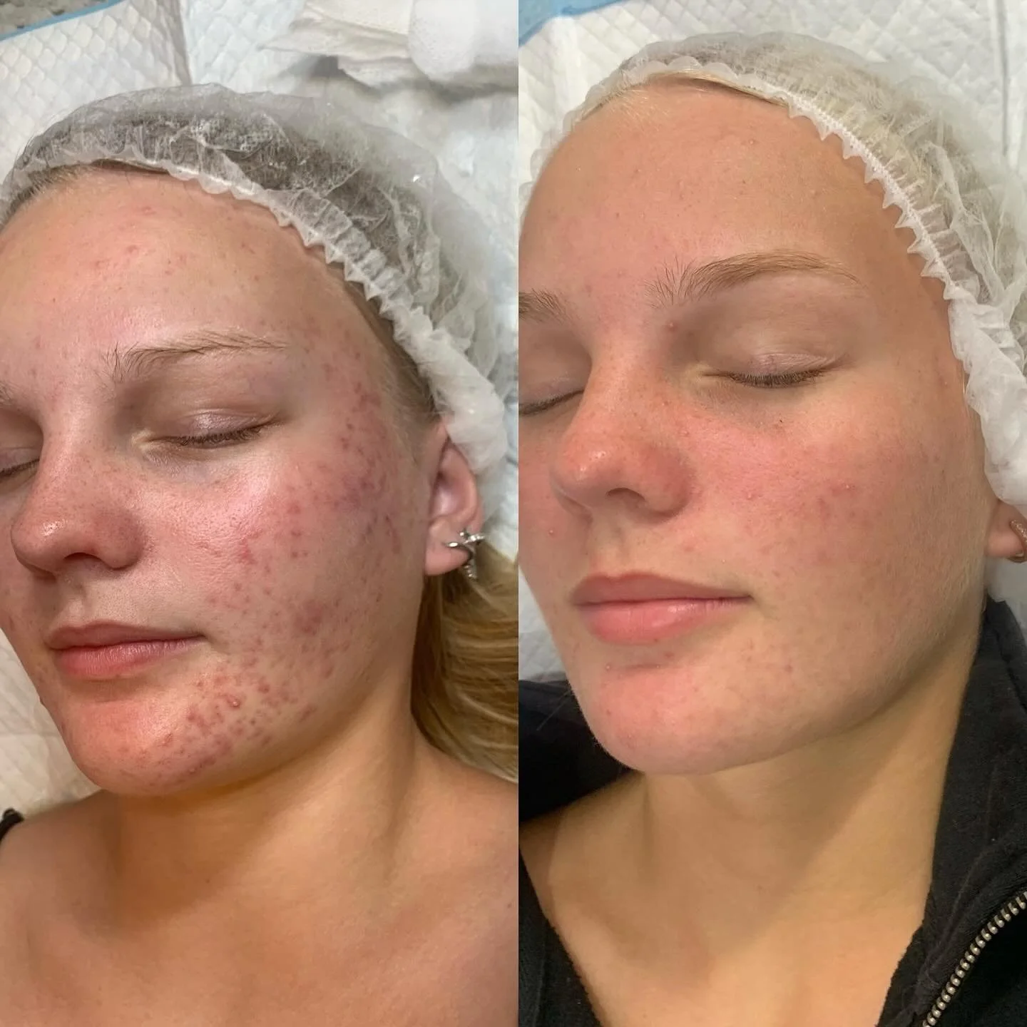 Before & After a Series of Treatments Including microdermabrasion