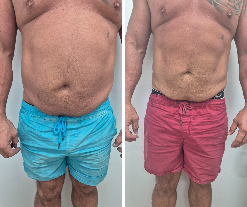 Two Sessions of Fat Freezing in conjuction with EMS
