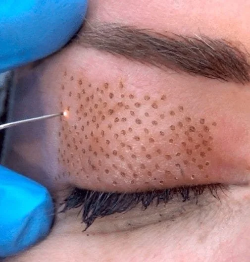 PLASMA FIBROBLAST EYELID - IN PROGRESS