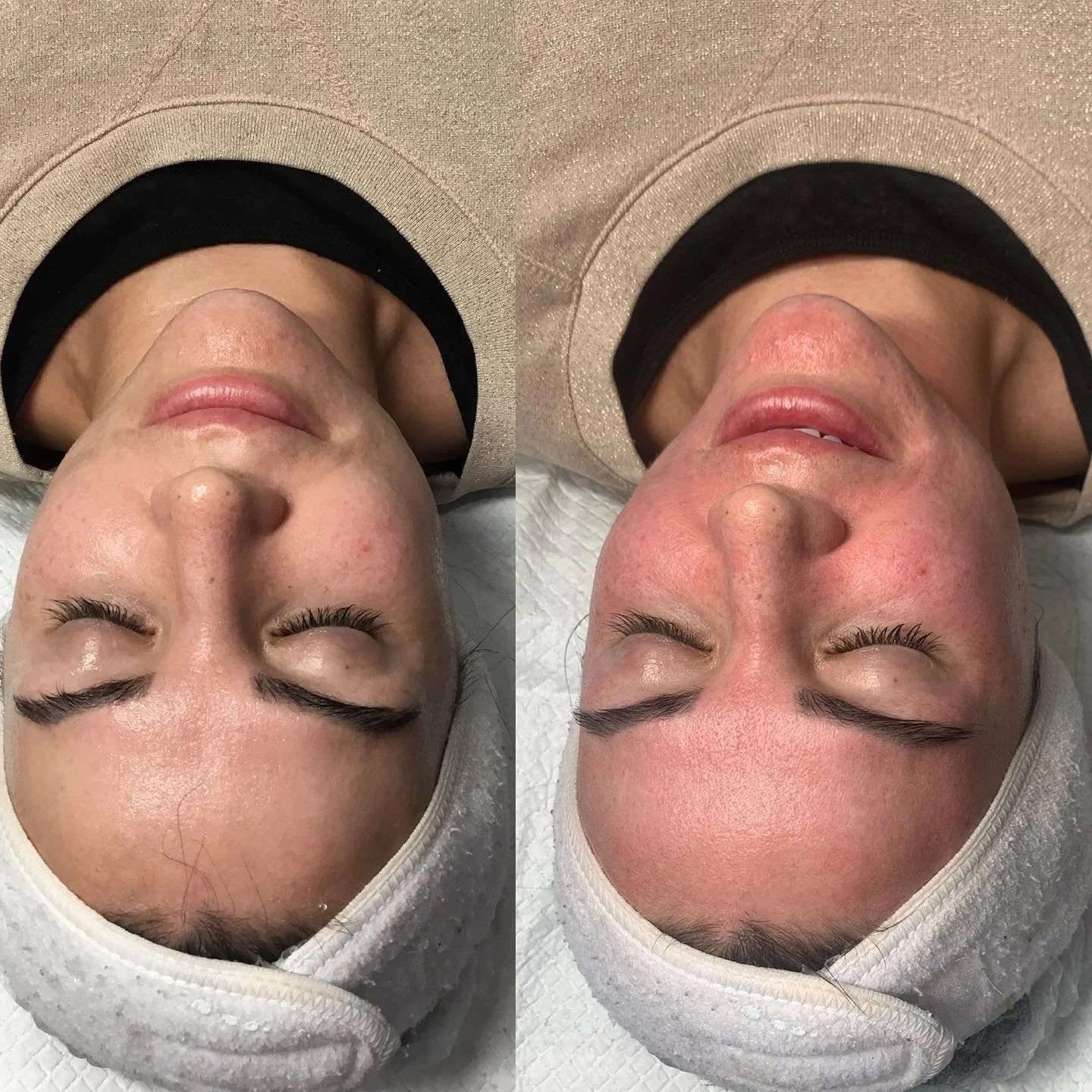 Close-up of a woman's face showing before and after facial treatment, with her eyes closed, wearing a white headband, and lying down with her head on a pillow.
