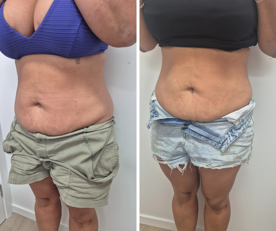 Two Sessions of Fat Freezing in conjuction with EMS
