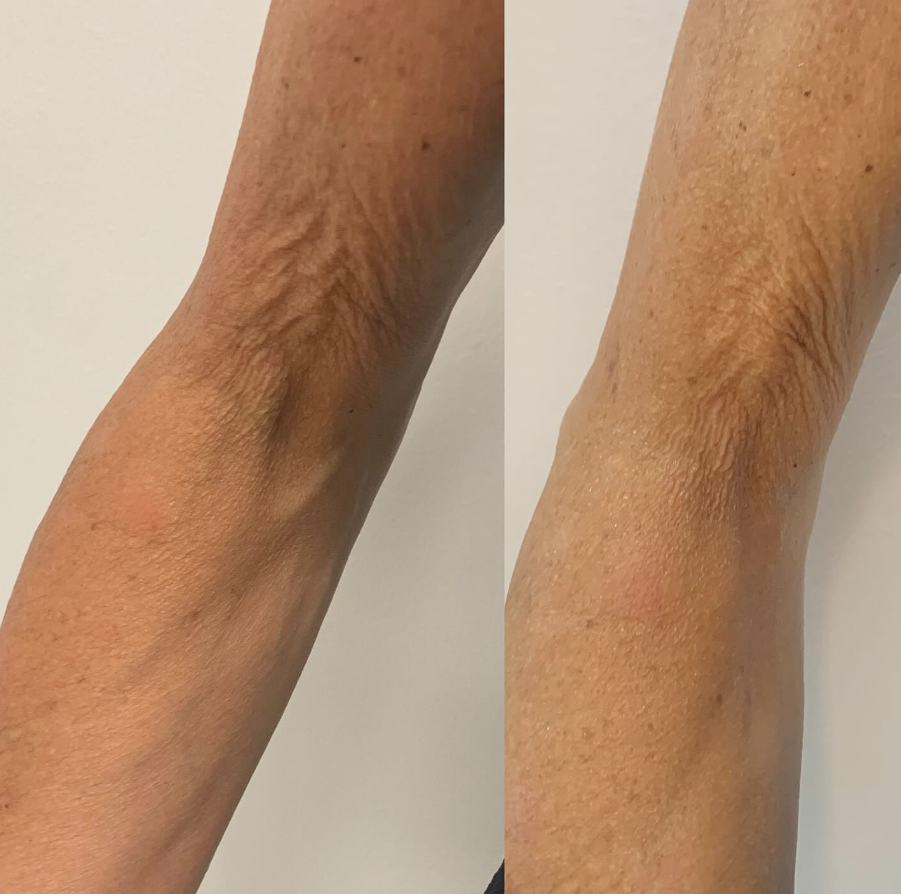 Before and After - RF Skin Tightening Treatment to Arm