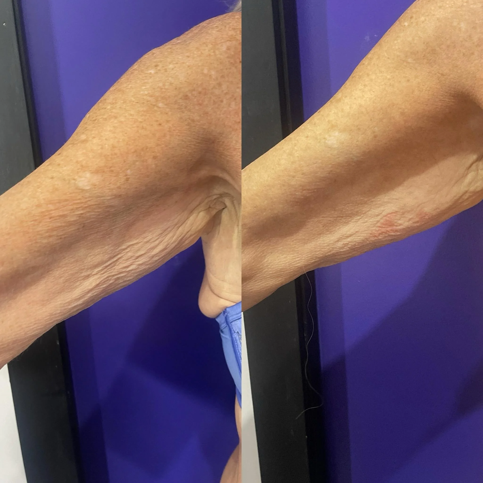 BEFORE AND AFTER 4 SESSIONS EMS to arms
