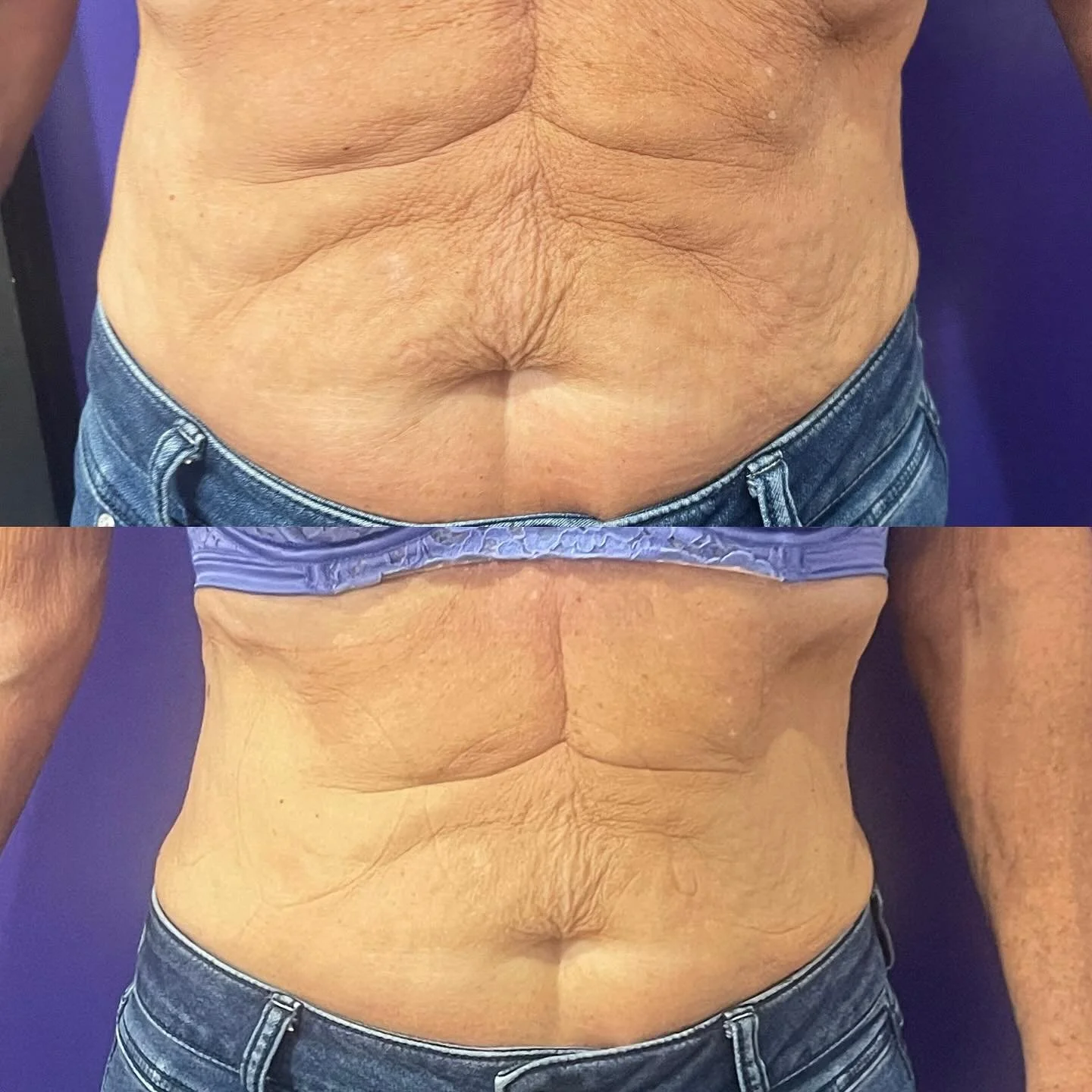 Before and Immediately after one session EMS