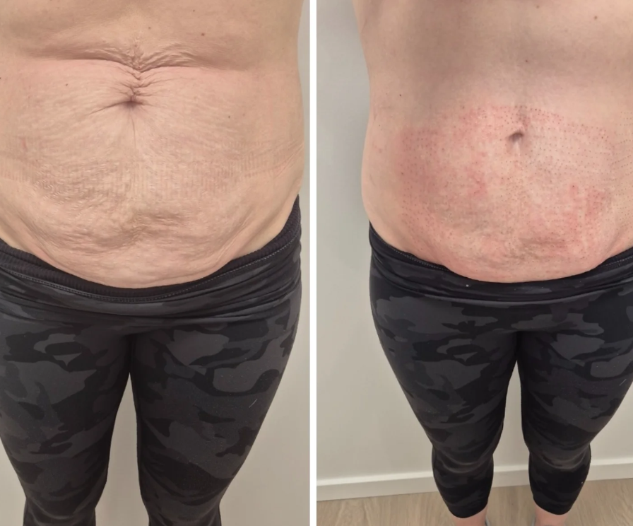 Before and Immediately after plasma fibroblast (Also x1 HIFU Session Prior to Treatment)