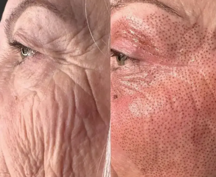 BEFORE AND IMMEDIATELY AFTER - HALF FACE