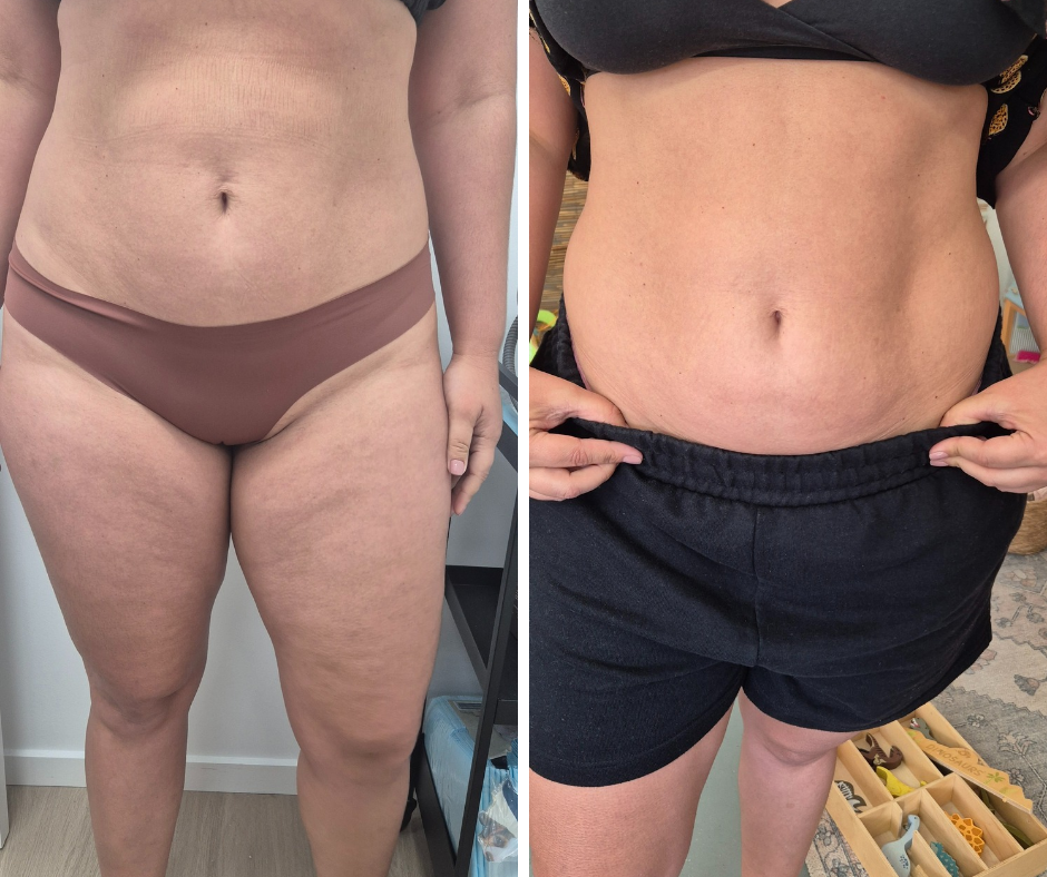 One session fat freezing before and 4 weeks later