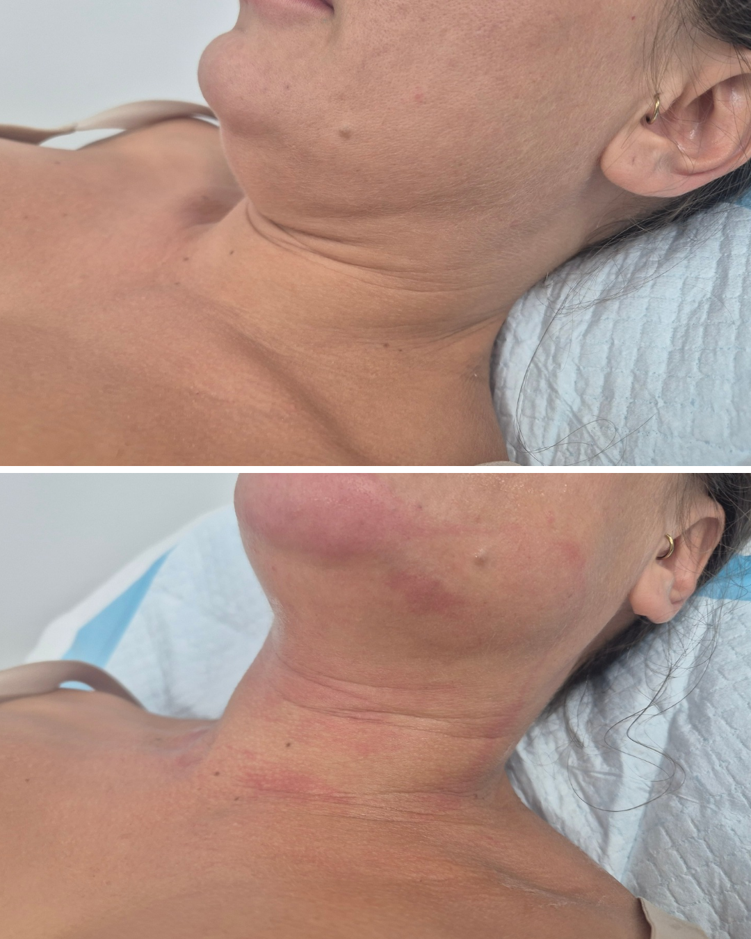 Before & Immediately After HIFU - Neck / Chin Area 