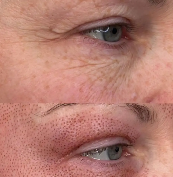 BEFORE AND IMMEDIATELY AFTER - EYELIDS