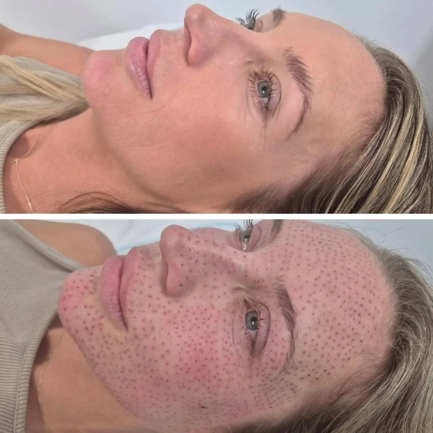 Full Face - Before & Immediately After