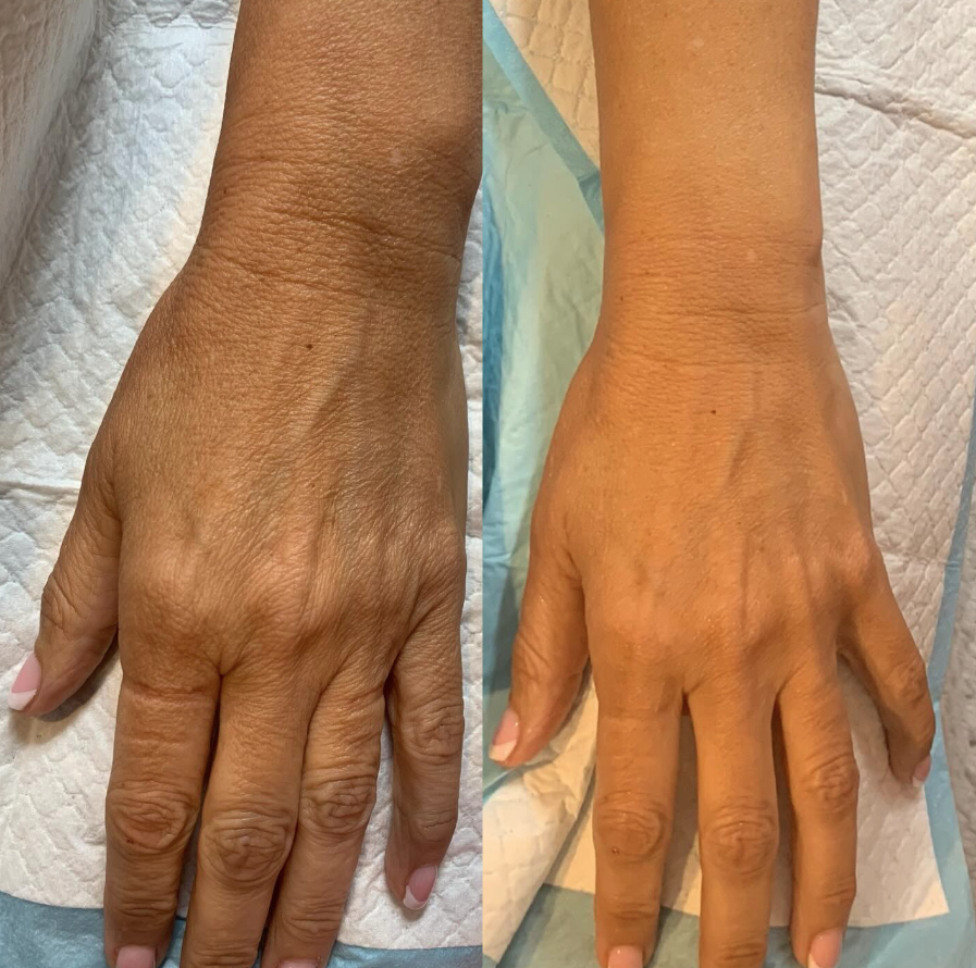 Before & After Hifu to hand