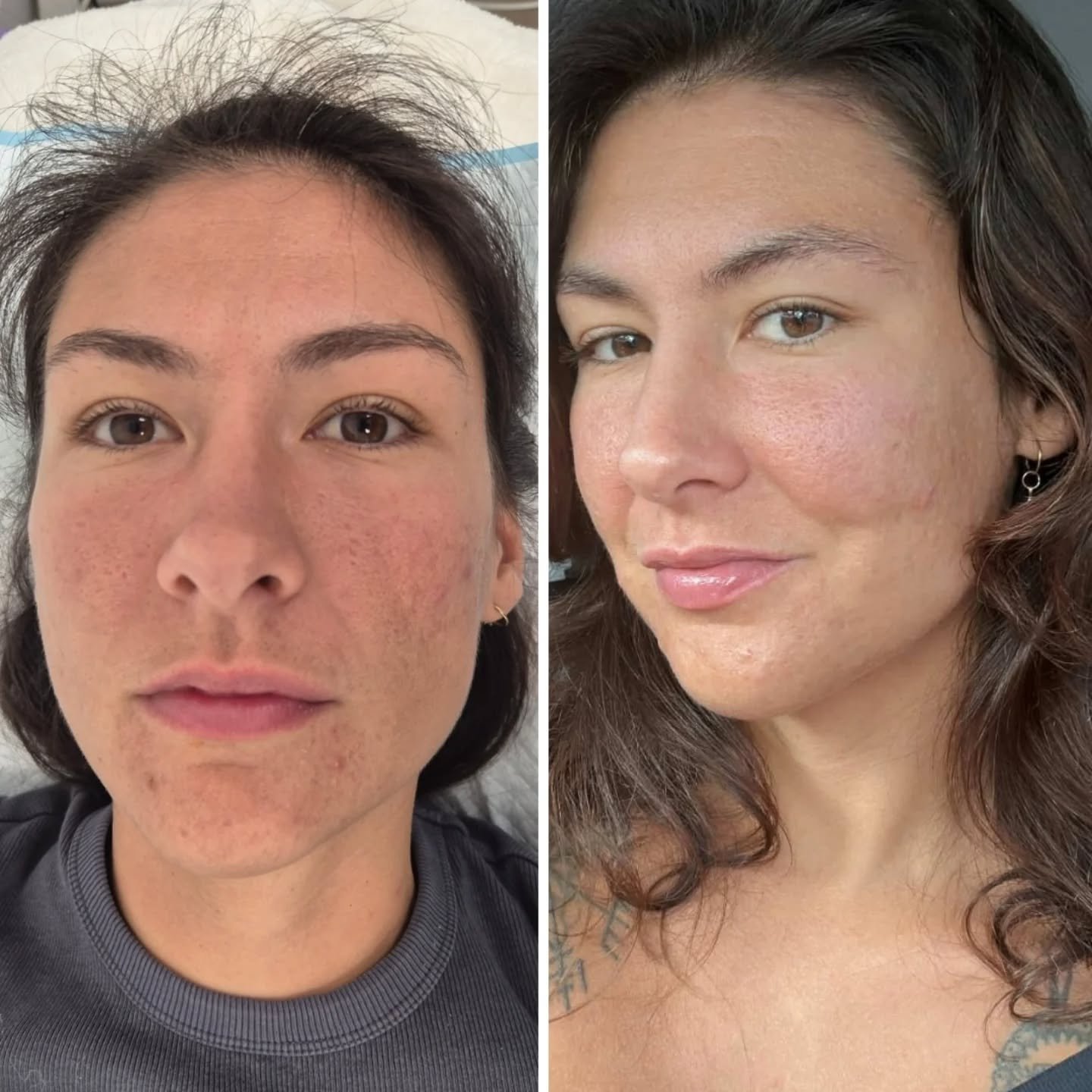 Before and After a Series of Treatments including microdermabrasion