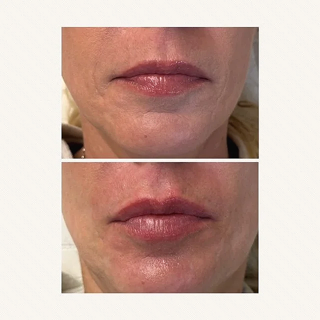 A side-by-side comparison of a person's lips and chin before and after a cosmetic treatment, showing smoother skin and fuller lips in the after image.