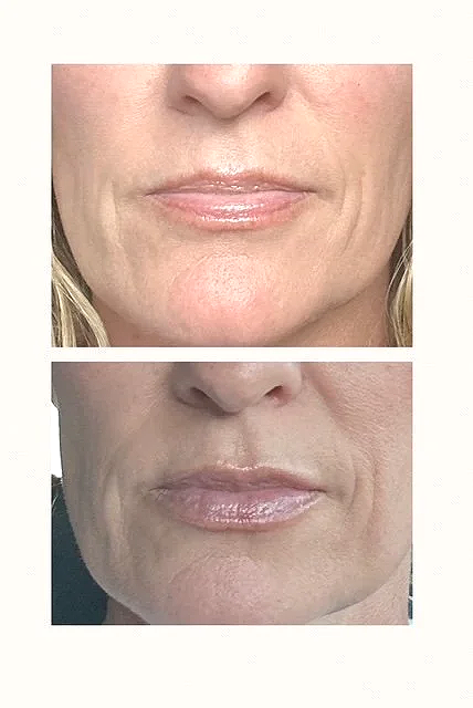 Close-up of a woman's lips and chin showing a before-and-after comparison of a cosmetic or skincare treatment.