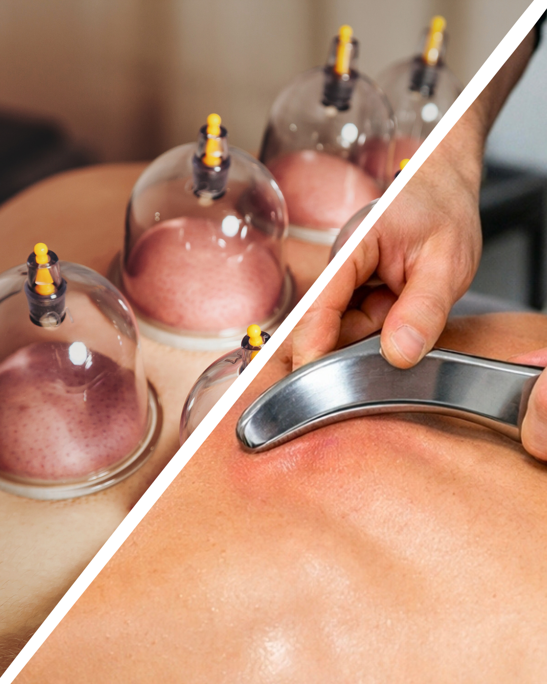 A collage showing cupping therapy with glass cups on a person's back on the left side and a person receiving a massage with a metal tool on their back on the right side.