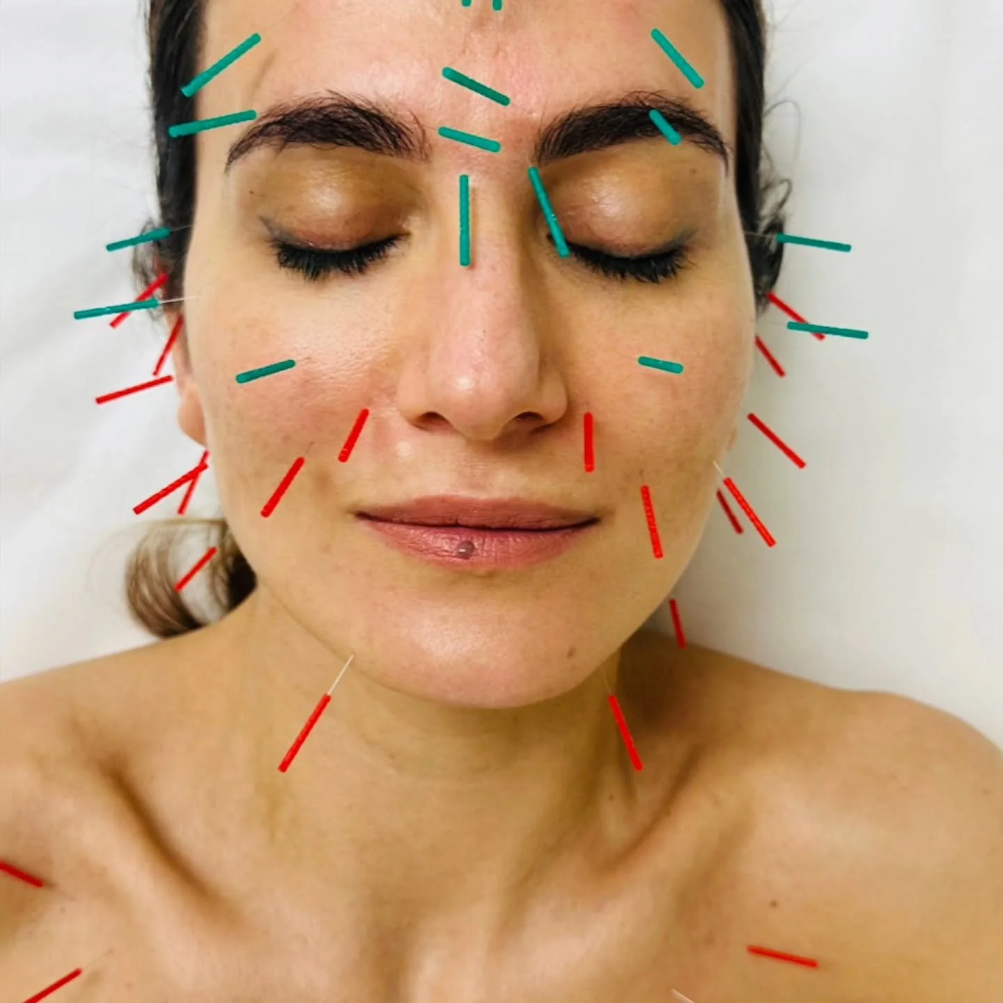 ✨ It&rsquo;s always a pleasure taking care of you, Regina ✨

https://www.facebook.com/100046989722371/posts/1381094436800201/?mibextid=rS40aB7S9Ucbxw6v

Regular cosmetic acupuncture sessions have helped her achieve a naturally lifted, radiant glow &m