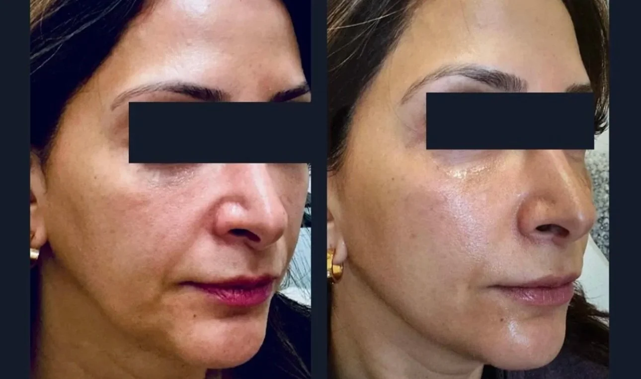 Signature Sculptra Facial Treatment