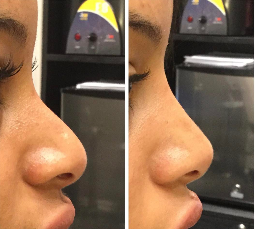 Nose Augmentation