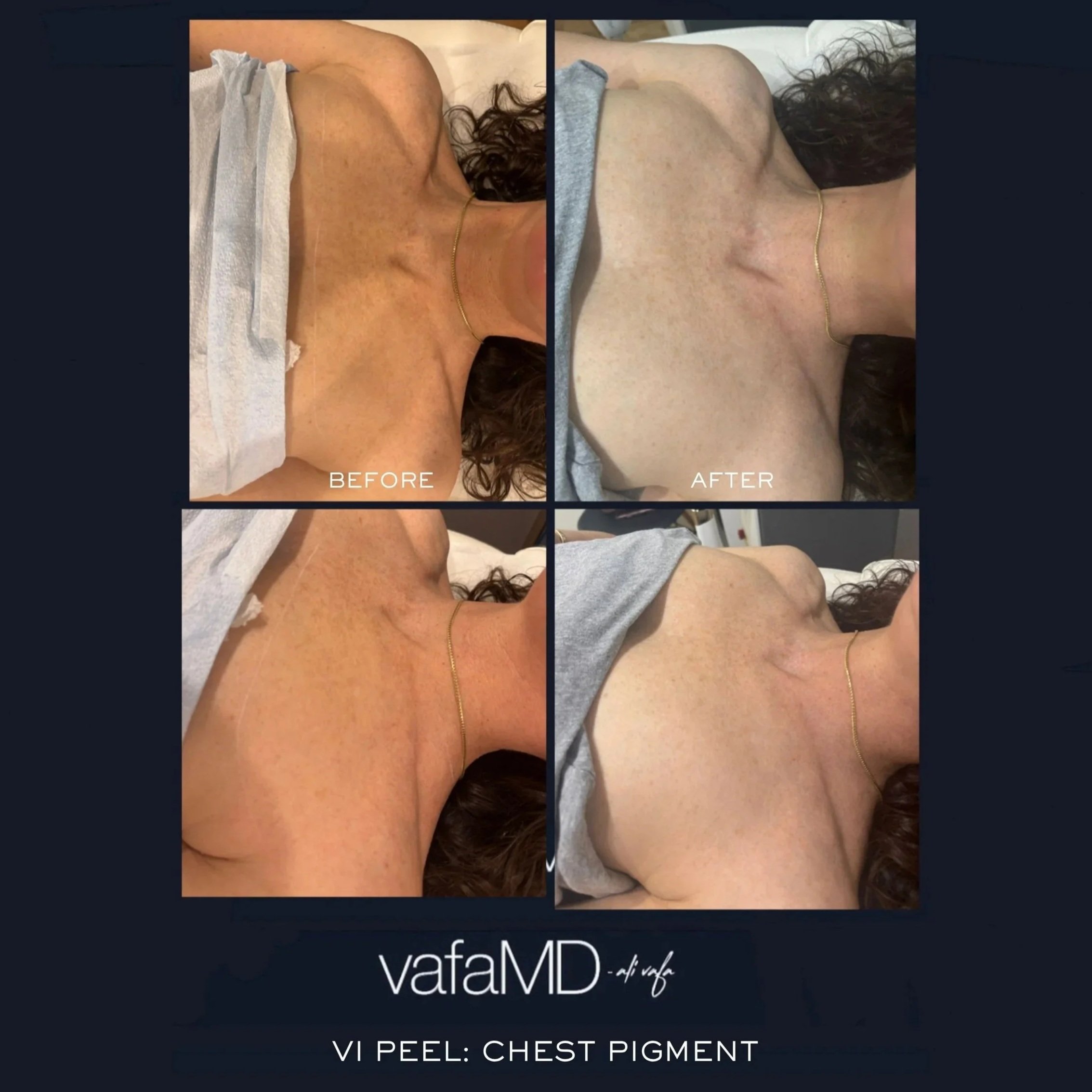 VI%2BPEEL%2BCHEST%2BPIGMENT.jpg