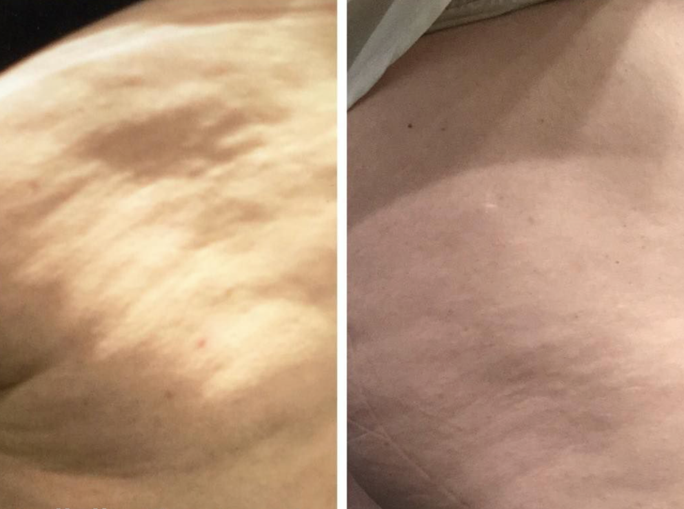 Cellulite + Dimpling