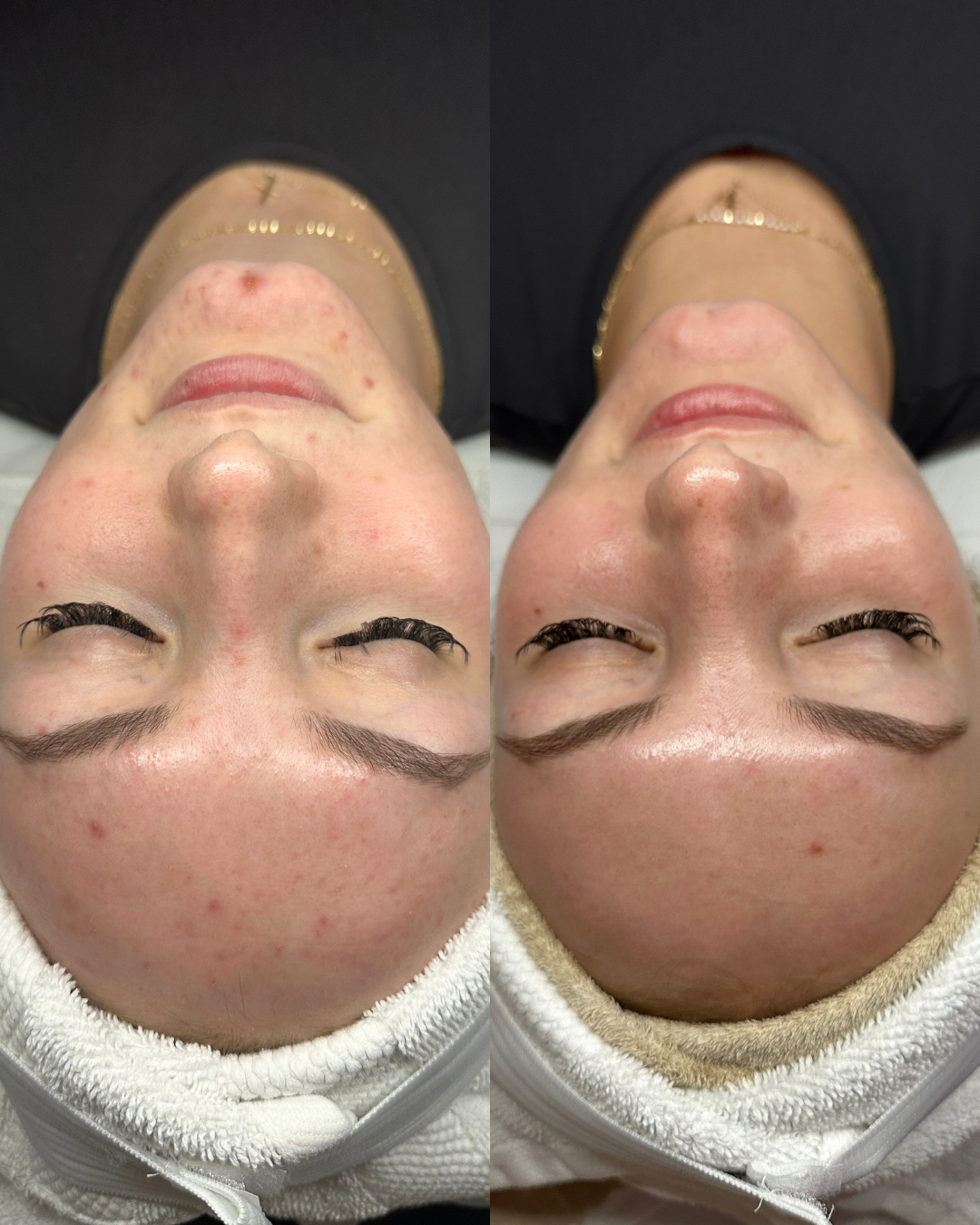 Side-by-side comparison of a woman's face before and after a skincare treatment, showing improvements in skin texture and acne reduction.