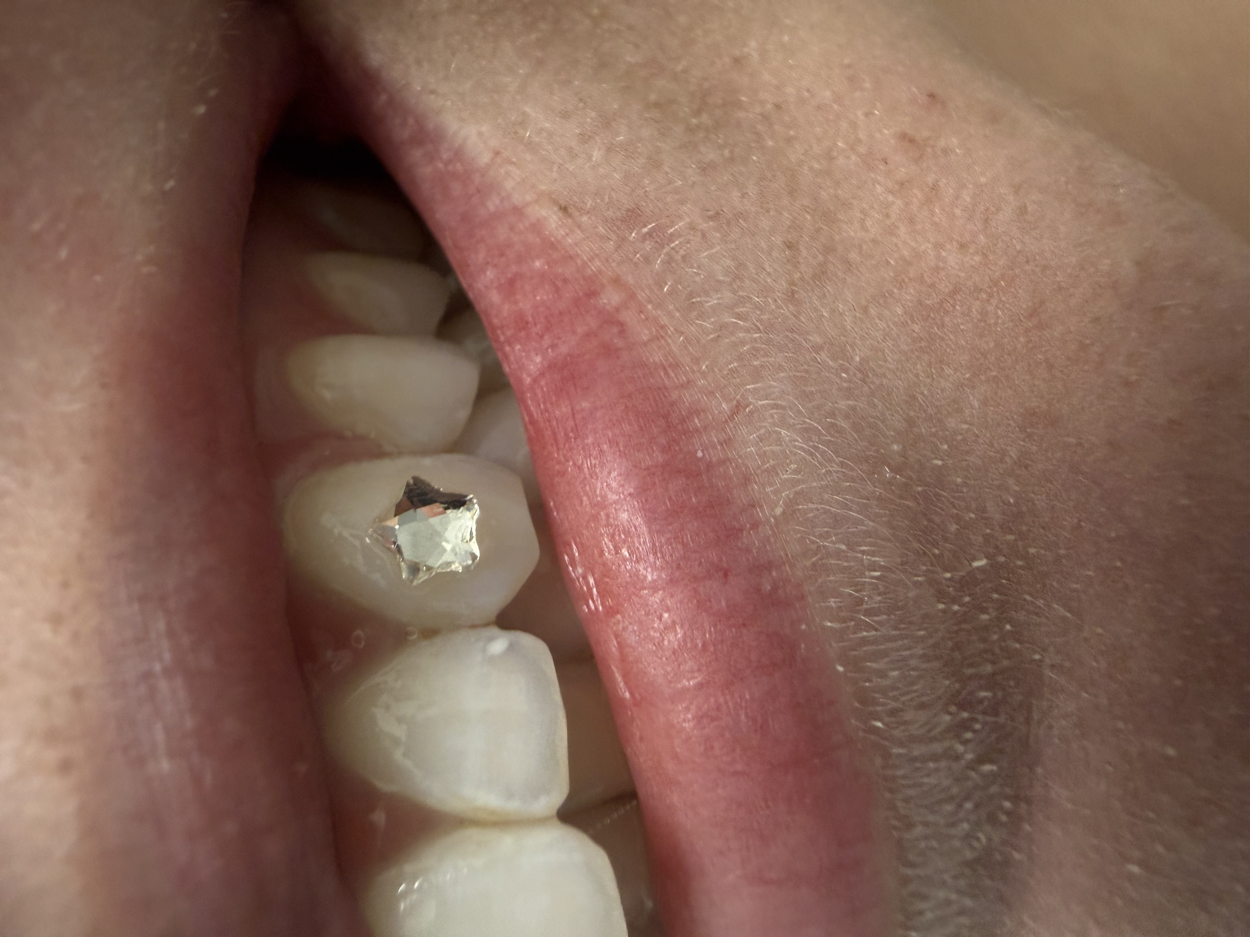 Close-up of a person's tongue and teeth, with a diamond embedded in the tooth.