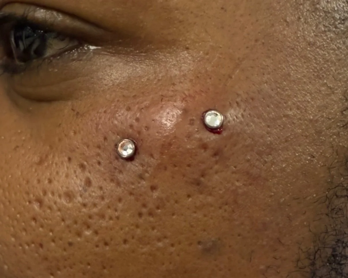 Close-up of a person's face showing two dermal piercings with rhinestone jewelry.