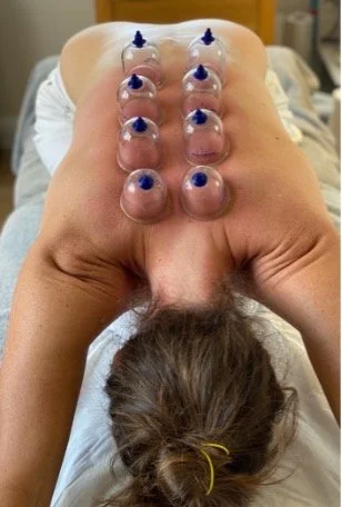 Person lying face down with multiple cups applied to their back for cupping therapy.