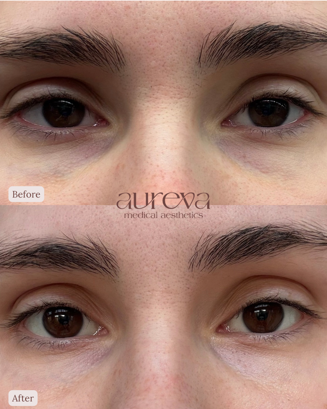 Close-up of a person's eyes before and after cosmetic treatment, showing improved appearance of under-eye area with reduced puffiness and dark circles.