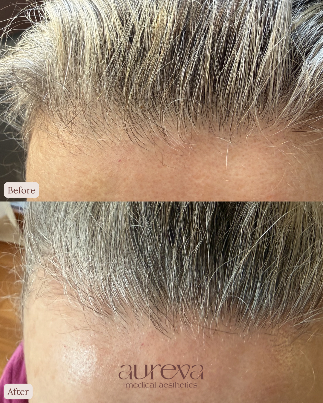 Before and after images showing a person's forehead with improved hair density and coverage following a cosmetic procedure by Aureva Medical Aesthetics.