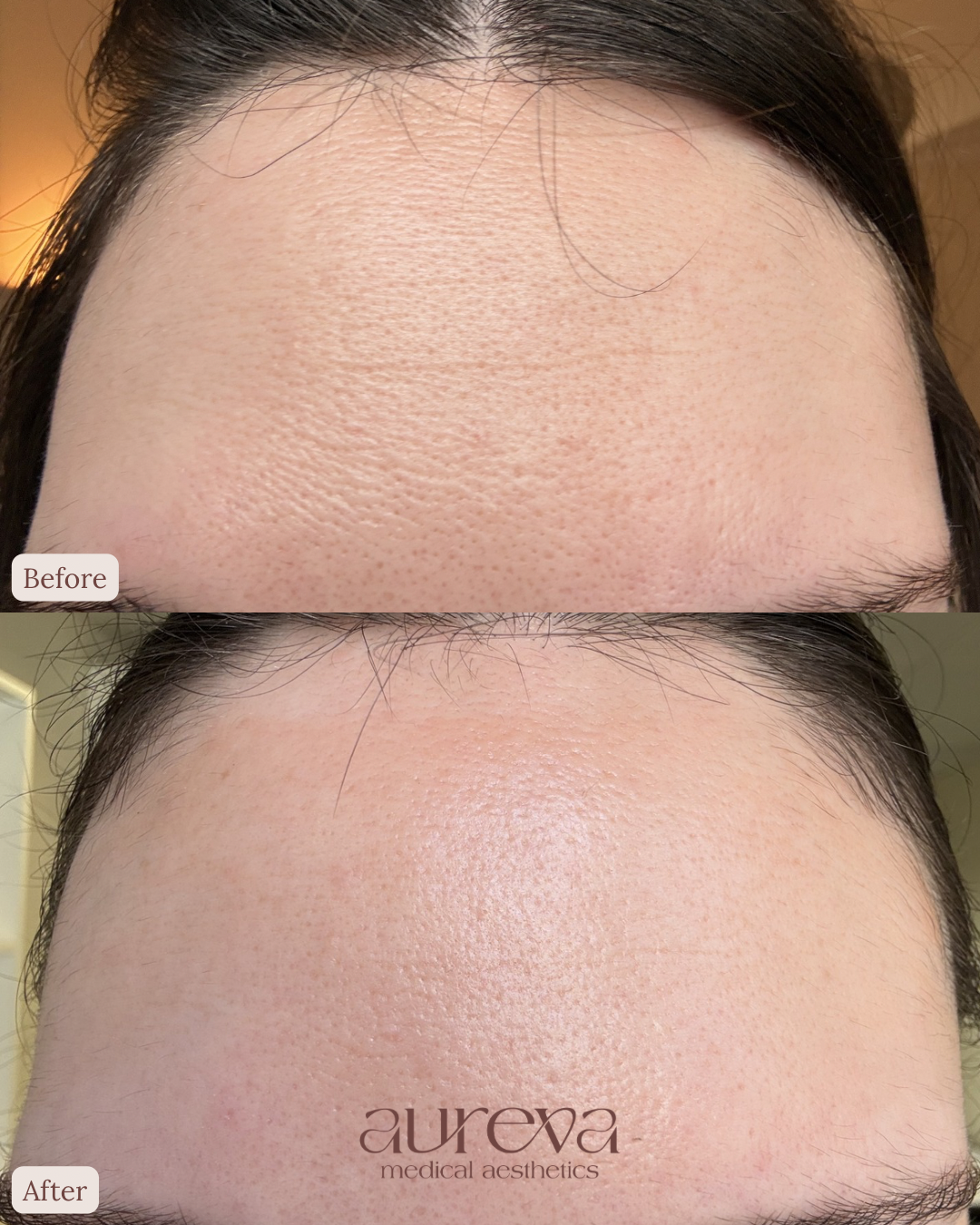 Close-up of a person's forehead before and after skin treatment showing reduced pore size, smoother skin, and improved skin texture.
