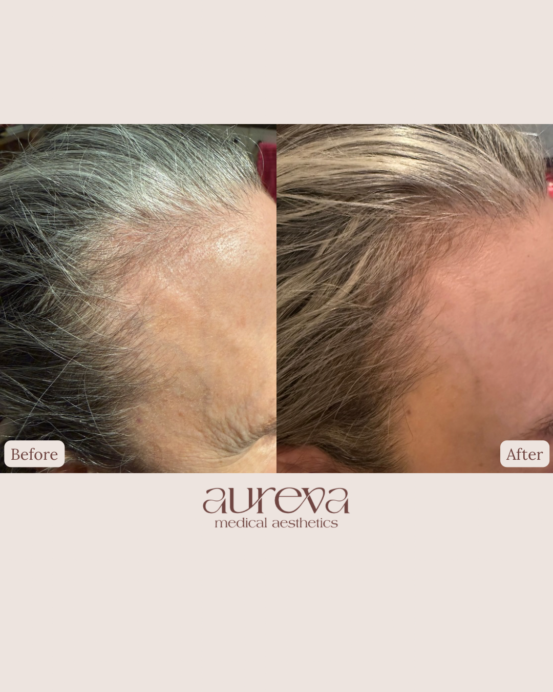 Before and after images of a woman's forehead from a side perspective showing improved hair density and coverage after a cosmetic treatment at Aureva Medical Aesthetics.