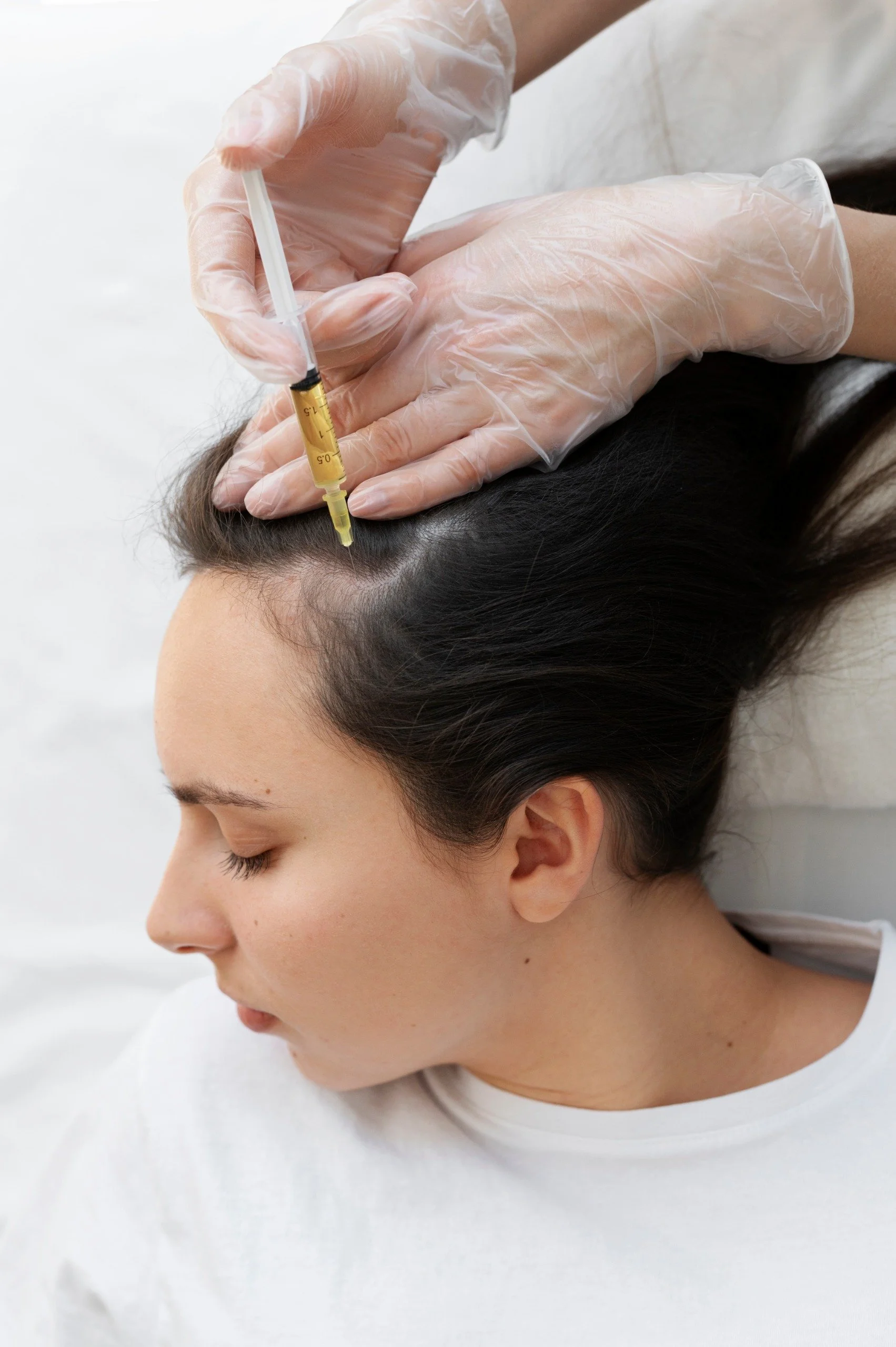 A person with dark hair lying down with their eyes closed, receiving a cosmetic injection in the scalp area from a healthcare professional wearing gloves.