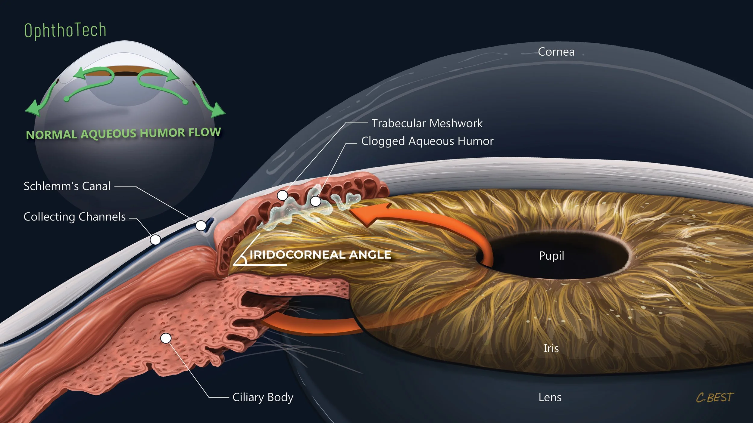 CBest_A3_IridocornealFinal_20251206.jpg