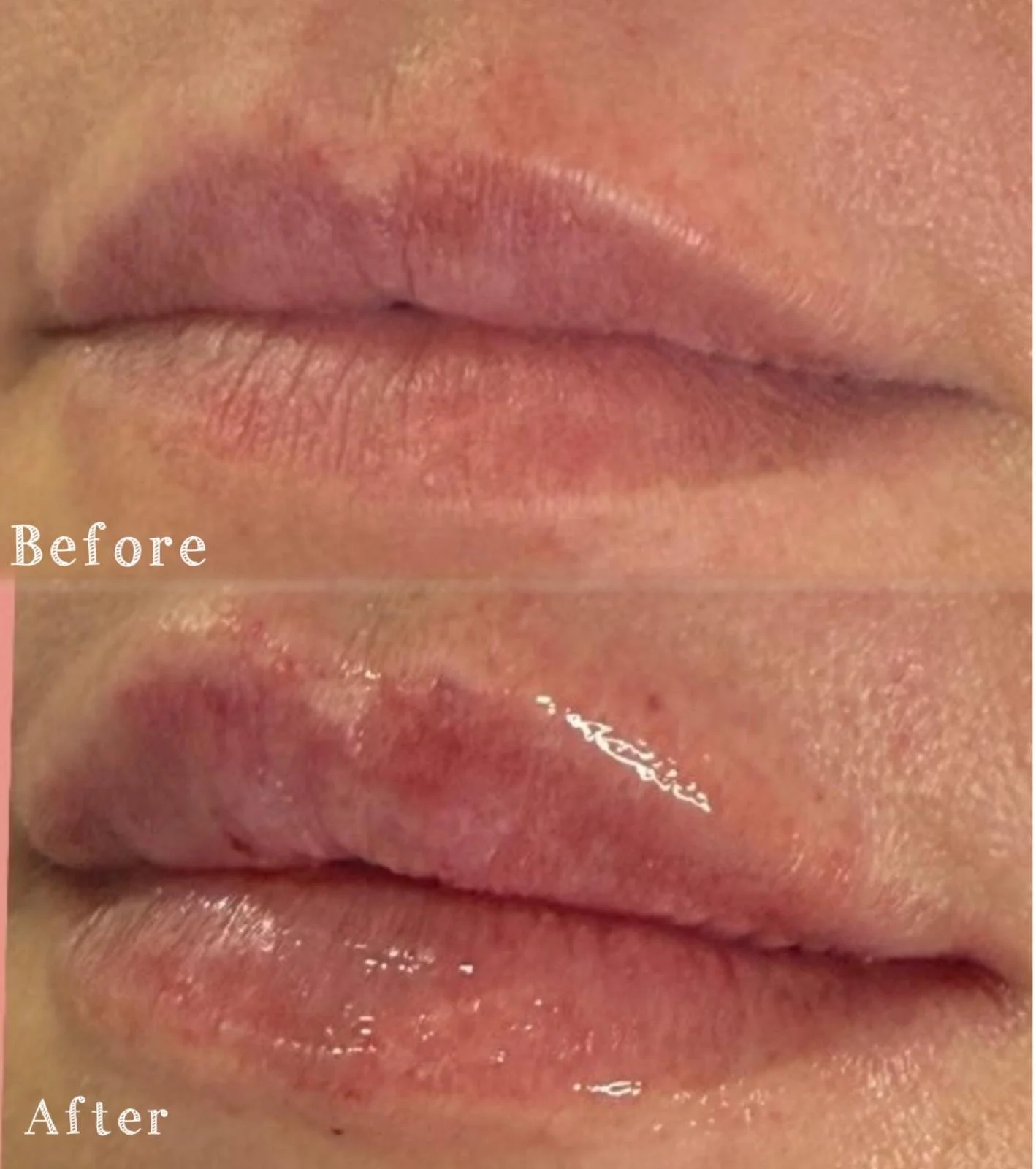 Close-up of lips showing improvement after treatment with visibly smoother, more hydrated lips in the 'after' image.