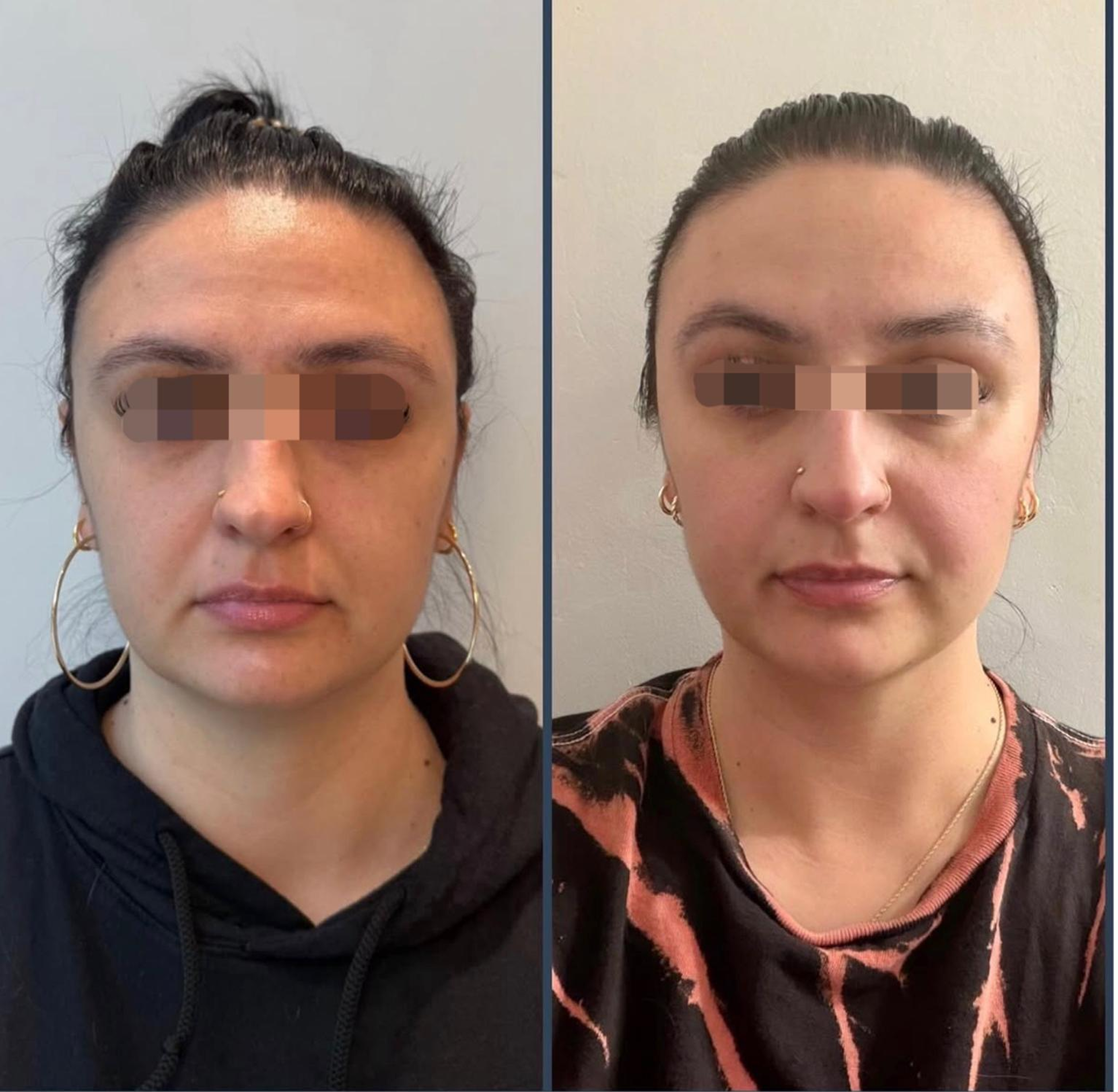 Before and after images of a woman showing hair restoration, with the left side depicting her with thinning hair and the right side showing thicker, fuller hair.