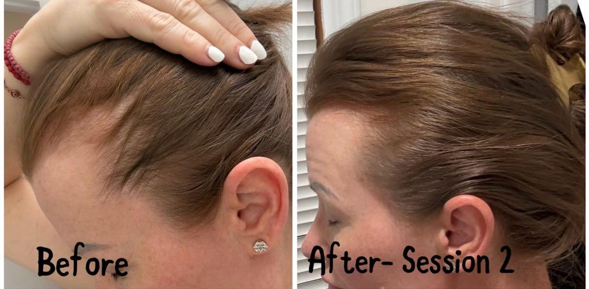 Side-by-side comparison photo of a woman's scalp, showing initial thinning hair on the left and thicker hair after two treatment sessions on the right.