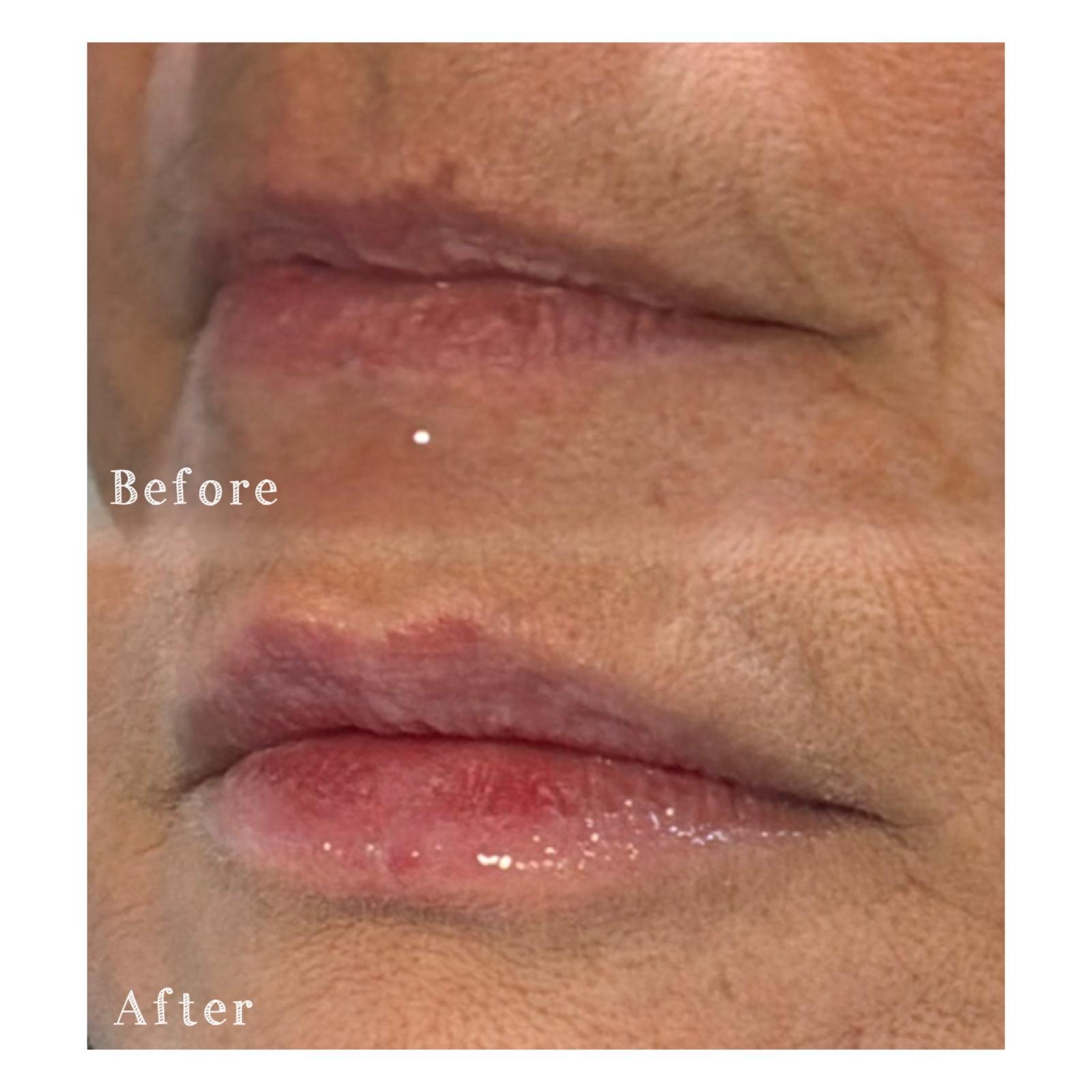 Close-up of lips showing before and after improvement, with the word "Before" on the top image and "After" on the bottom image.