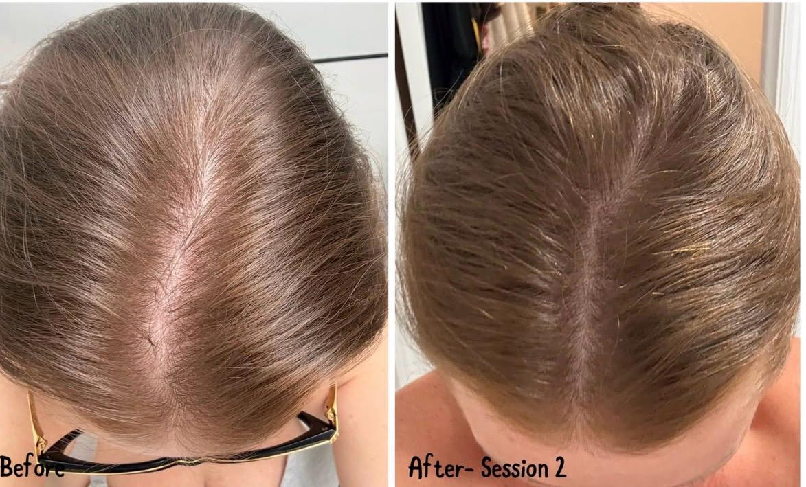 Comparison of a woman's scalp before and after a hair treatment, showing increased hair density and volume on the right side.