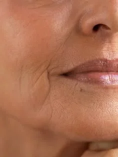 Close-up of a woman's face showing wrinkles and skin texture around her mouth.