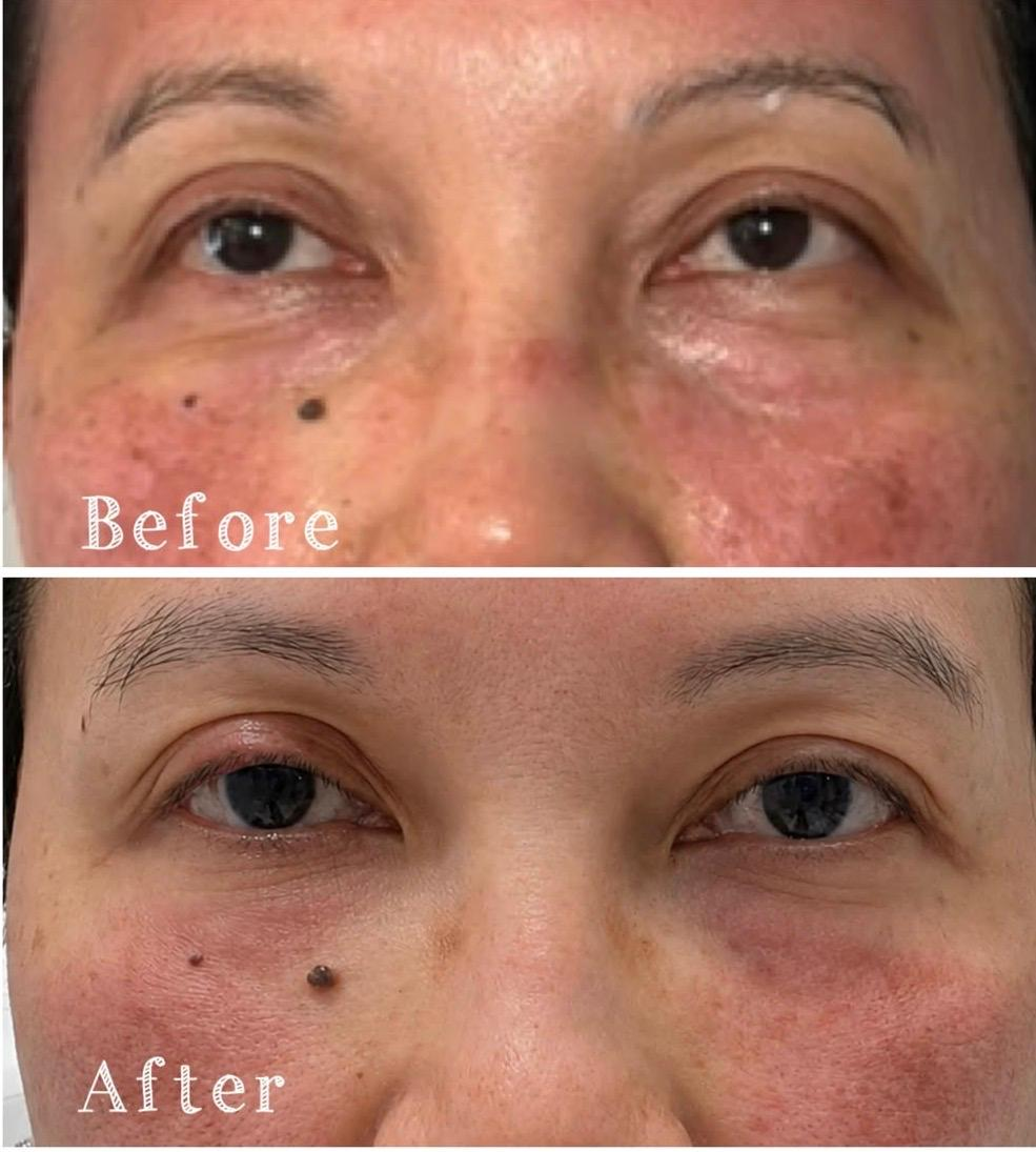 Close-up of a person's face showing before and after images of skin improvement around the eyes, with fewer wrinkles and clearer skin in the after photo.