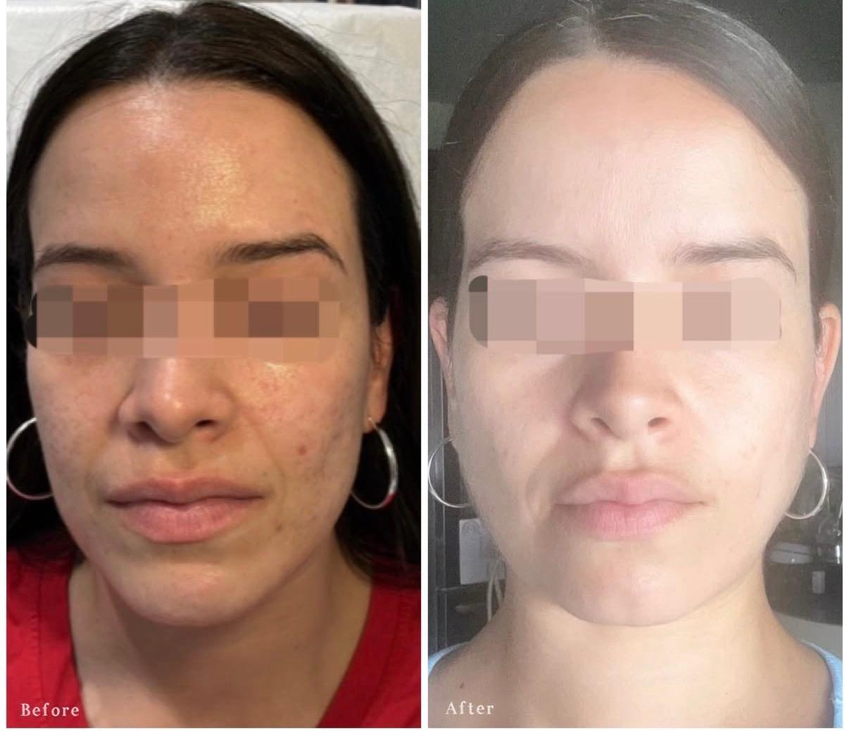 Side-by-side comparison of a woman before and after skincare treatment, showing improved skin clarity and texture.